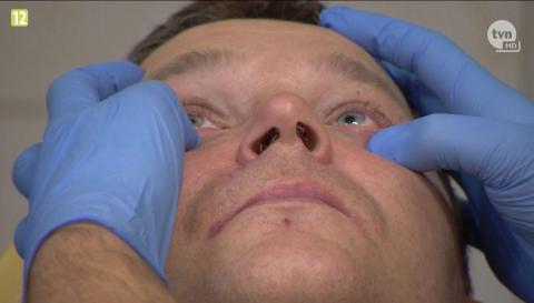 Pabianicka Fabryka Narzędzi zrobiła implanty twarzy dla szofera z Katowic